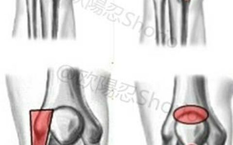 "膝關節康復訓練：7個動作康復髕腱炎，髂脛束症候群緩解膝蓋疼痛"